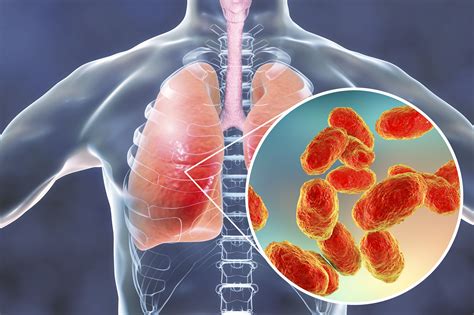 Respiratory infections caused by Haemophilus influenzae β.